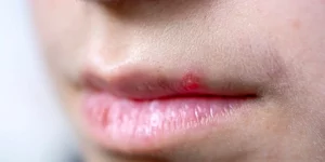 Pimple On Lip Line